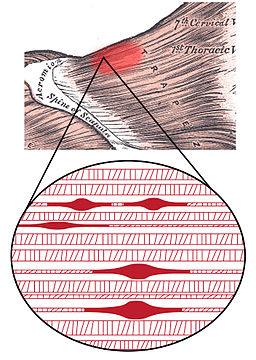 Trigger Points Guide - Head & Torso - Quick Reference Resource