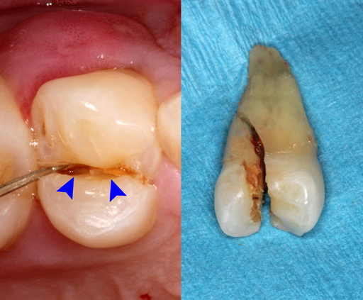 Cracked Tooth Restoration → Dentistry for Cracked and Split Teeth