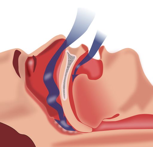 Obstruction ventilation apnée sommeil