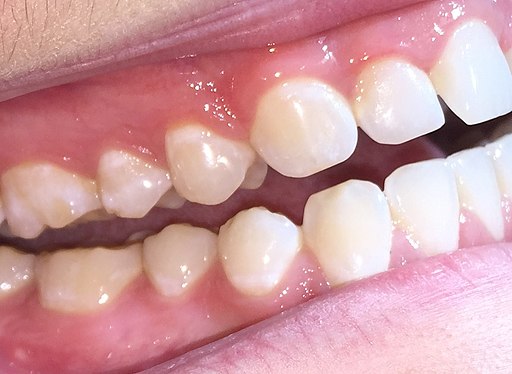 Typical Appearance of Dental Attrition of the Teeth