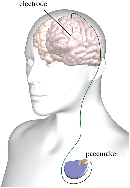 Typical deep brain stimulation setup