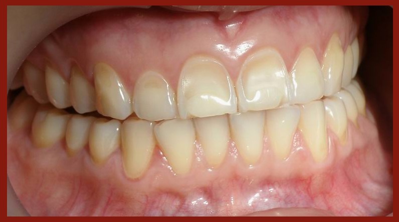 Dental erosion (hypoestrogenia) no211
