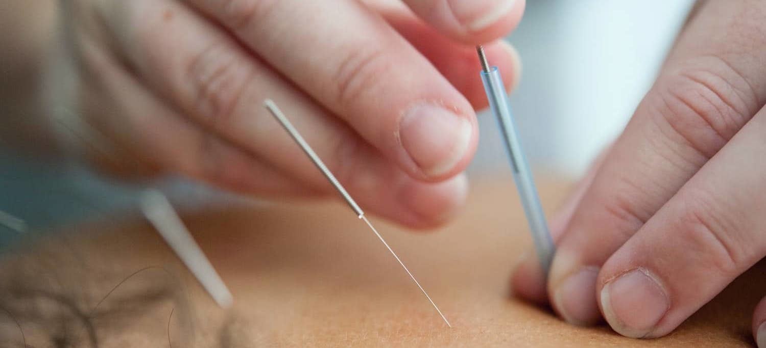 Acupuncturist performs acupuncture to relieve Osteoarthritis 