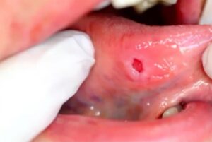Picture of traumatic ulcerative granuloma with stromal eosinophilia (TUGSE) on the tongue.