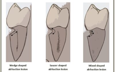 Dental Erosion from Abrasion & Abfraction