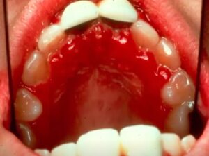 Diagnosing Mouth Herpes