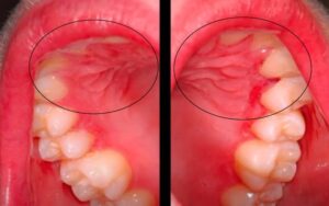 Gingival ulcerations of the oral cavity from a patient with Crohn's Disease