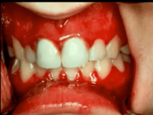 herpetic gingivostomatitis gums