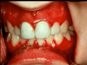 gingivostomatitis in babies