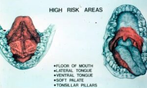 High risk areas for sqaumous cell carcinoma of the oral cavity picture.