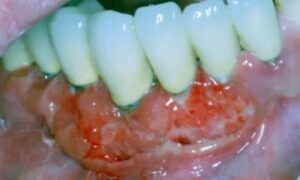 oral mucosal lesions pictures histoplasmosis picture deep fungal infection