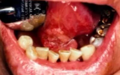 Oral Pathology of Oral Pharyngeal Squamous Cell Carcinoma & HPV