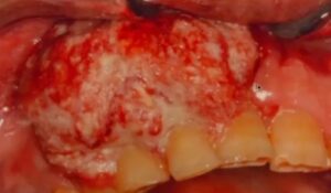 large ulcerative granulomatous lesion picture oral cavity gums