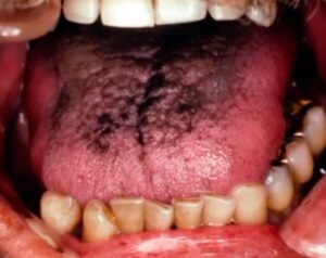mouth cancer with periodontitis hairy tongue