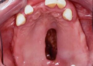 mucormycosis diagnosis picture oral cavity fungal infection lesion