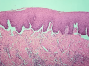 Mucous Membrane Pemphigoid Histology Picture