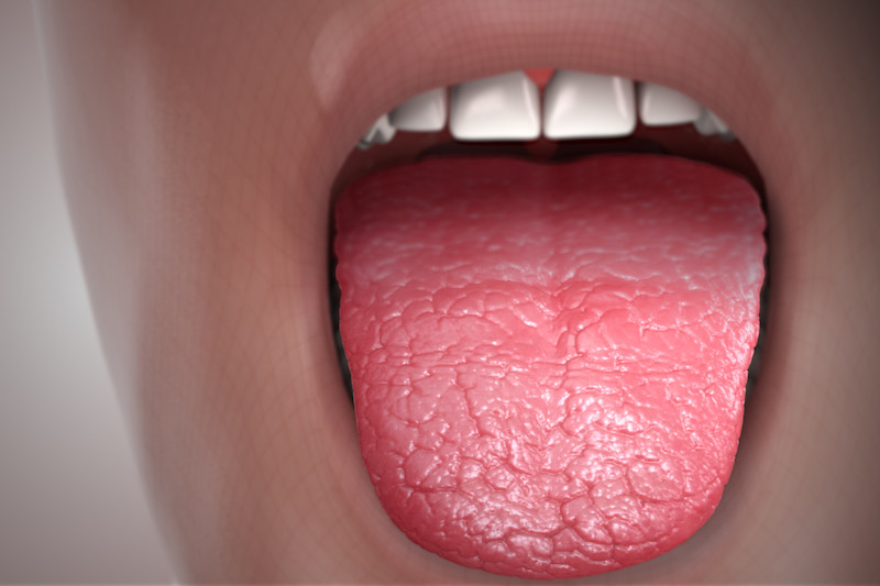 Picture of Xerostomia (Dry Mouth) in Older Adult Dental Patient