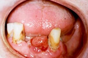 oral cavity squamous cell carcinoma picture mimicking pyogenic granuloma