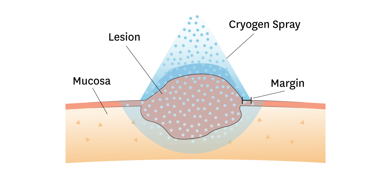 Oral Cryotherapy of a Lesion on the Oral Mucosa Lesion Being Applied with Cryogen Spray