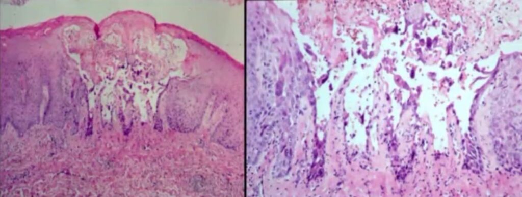 Histological Picture of Oral Herpes