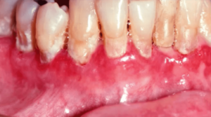 Oral Pemphigoid Picture