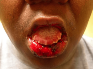 face ulcers pictures