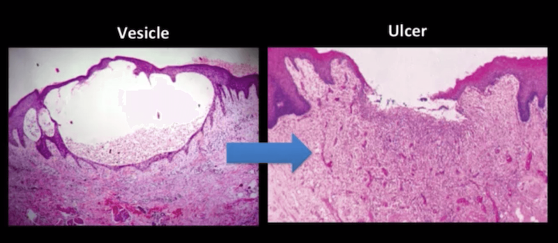 Mouth ulcers pictures. Differential diagnosis of a vesicle and an ulcer in the oral cavity.