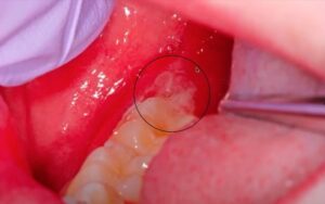 Oral ulceration of the right retromolar pad from a patient with crohns disease.