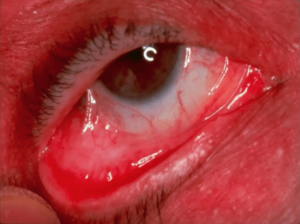 Ocular cicatricial pemphigoid pictures