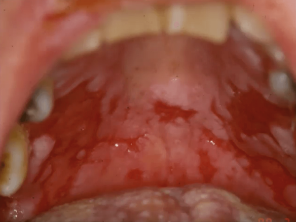 Pemphigus Vulgaris Throat Ulcers and Lesions in the Oral Cavity Picture