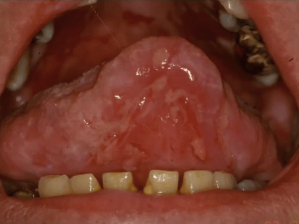 Pemphigus Vulgaris Tongue Ulcers and Lesions in the Oral Cavity Picture
