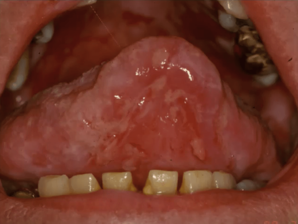 Pemphigus Vulgaris Oral Lesions