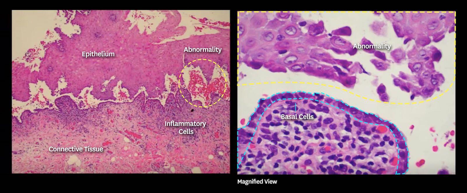 mucous membrane pemphigoid histology