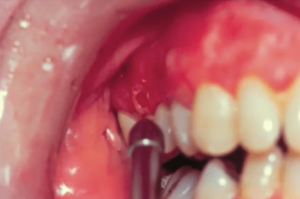 Diagnosing Pemphigus Vulgaris Mouth Ulcers with a Nikolsky Sign