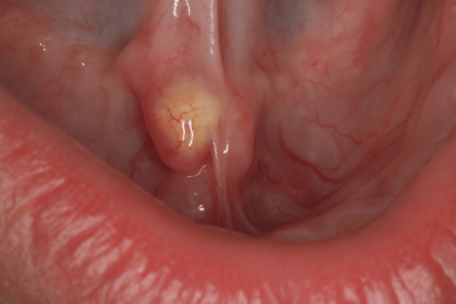 sublingual caruncle swelling