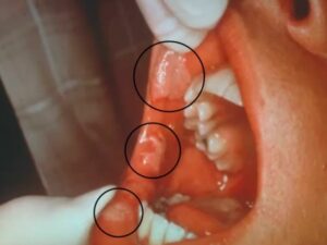 secondary syphilis mouth ulcer picture mucous patches