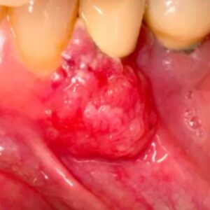 squamous cell carcinoma picture gingiva 1