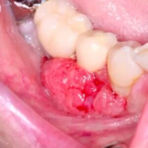 squamous cell carcinoma picture gingiva
