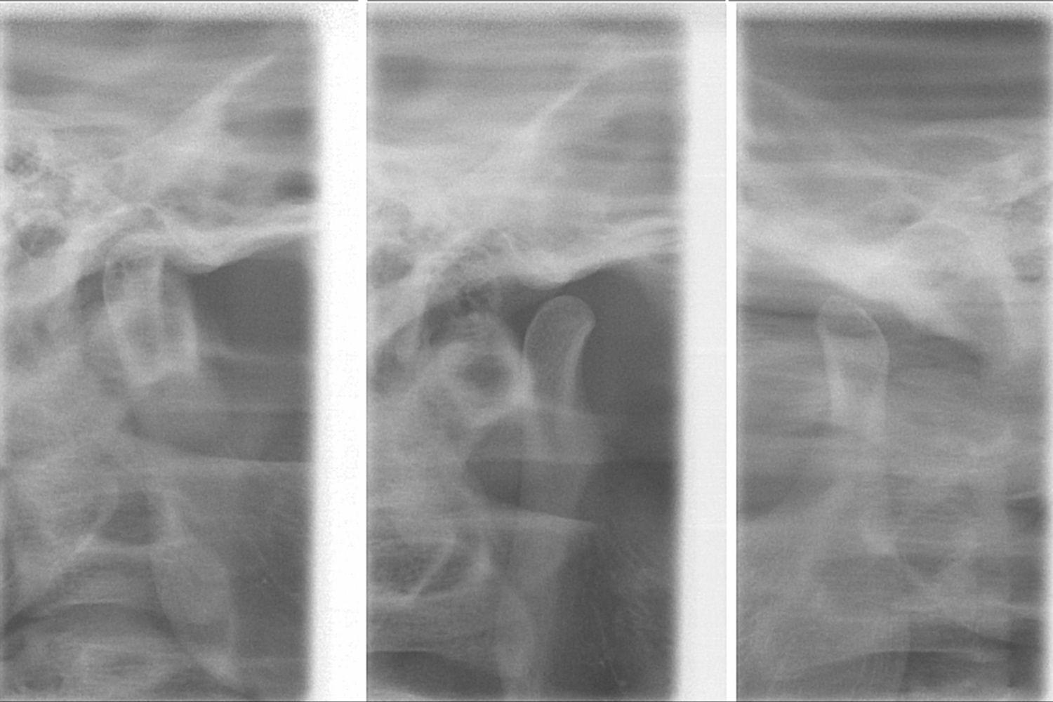 Tmj Assessment: Jaw Range Of Motion, Noise, And Tenderness