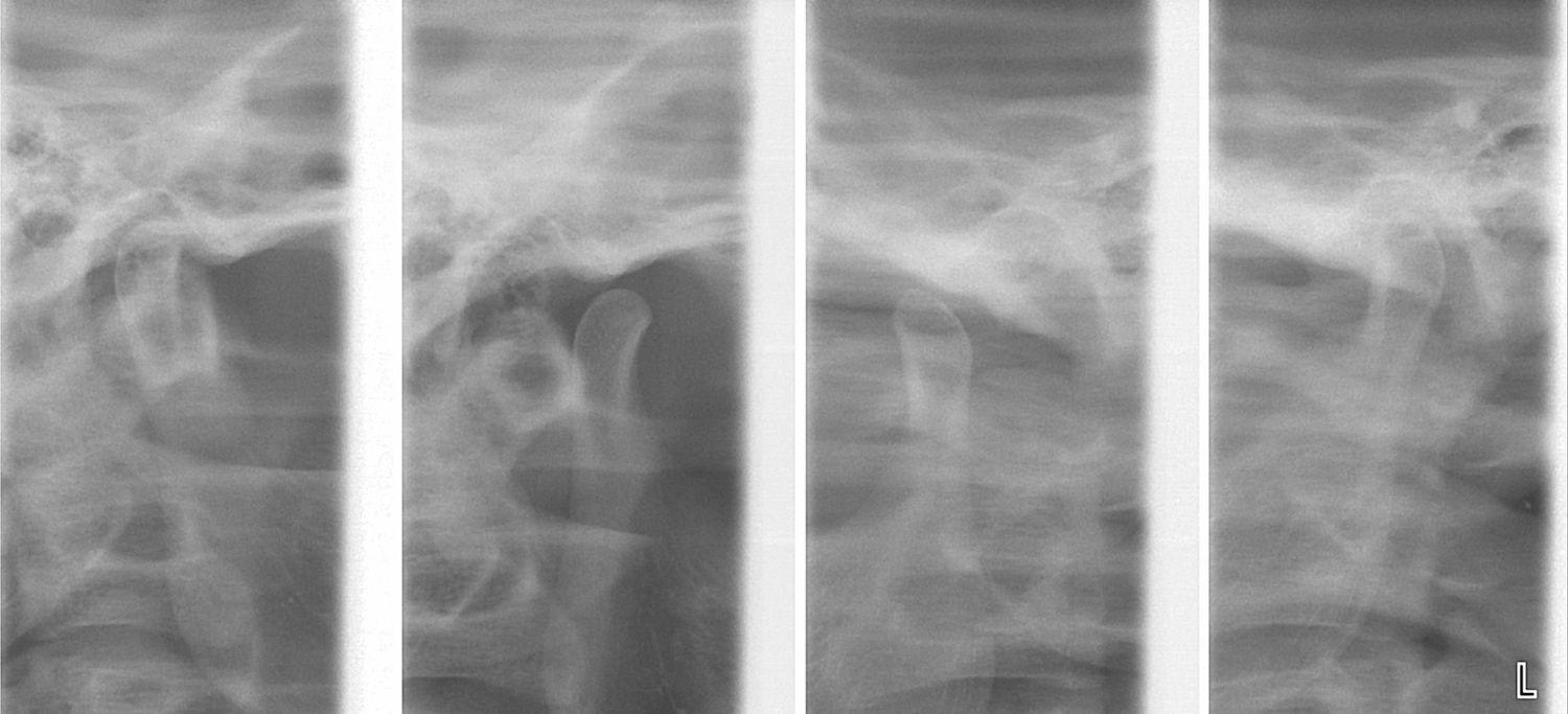 X-ray image showing articular fossa and condyle during a TMJ assessment