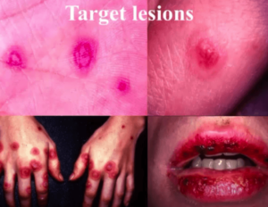 Bullous erythema multiforme picture of target lesions