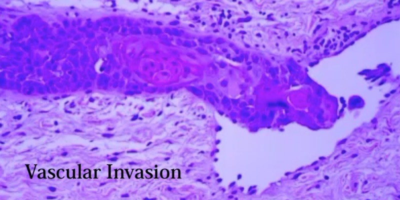 Histopathological features of oral squamous cell carcinoma.