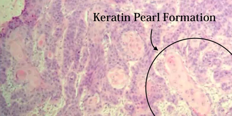 Squamous cell carcinoma histology picture of the oral cavity.