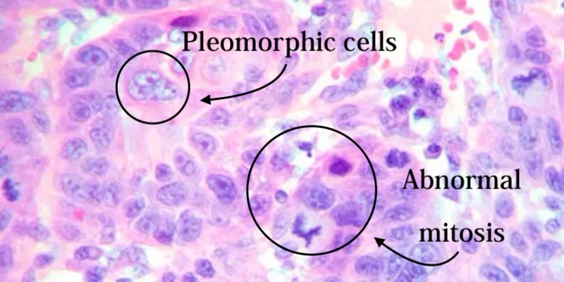 Pictures of squamous cell carcinoma pathology outlines of the oral cavity.