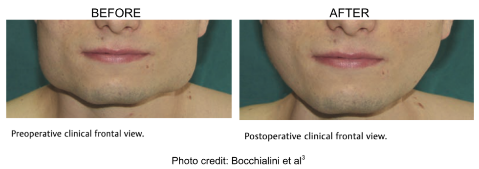 Masseter Muscle Hypertrophy To Chew Or Not To Chew