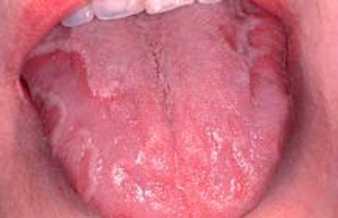 geographic tongue