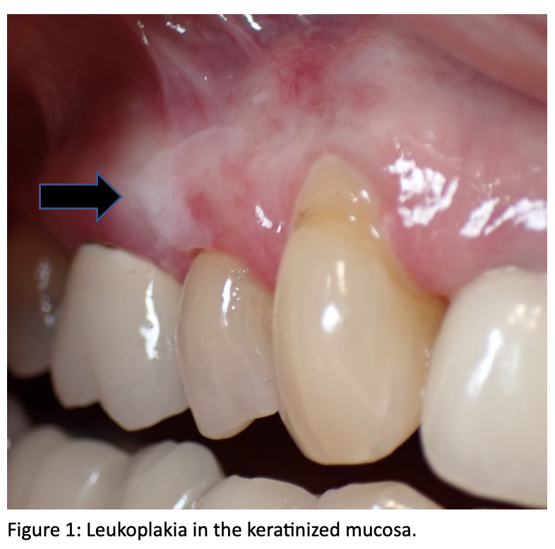Leukoplakia in the keratinized mucosa