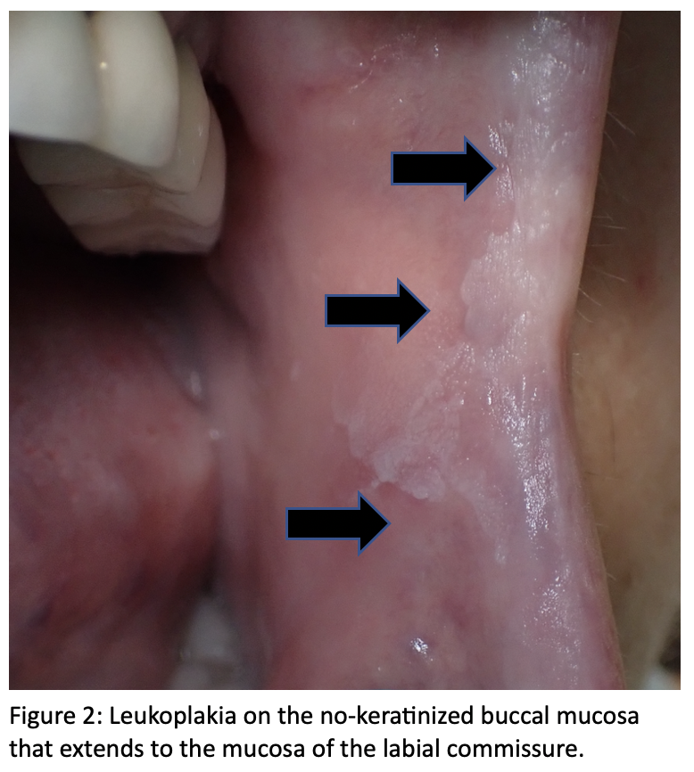 Leukoplakia on the no-keratinized buccal mucosa
