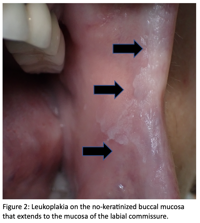 Clinical Manifestations Of Oral Proliferative Verrucous, 42% OFF