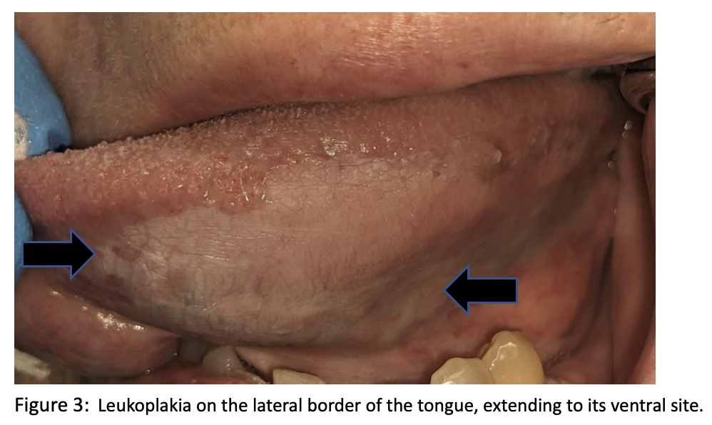 Leukoplakia on the lateral border of the tongue